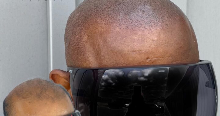 Scalp Micropigmentation